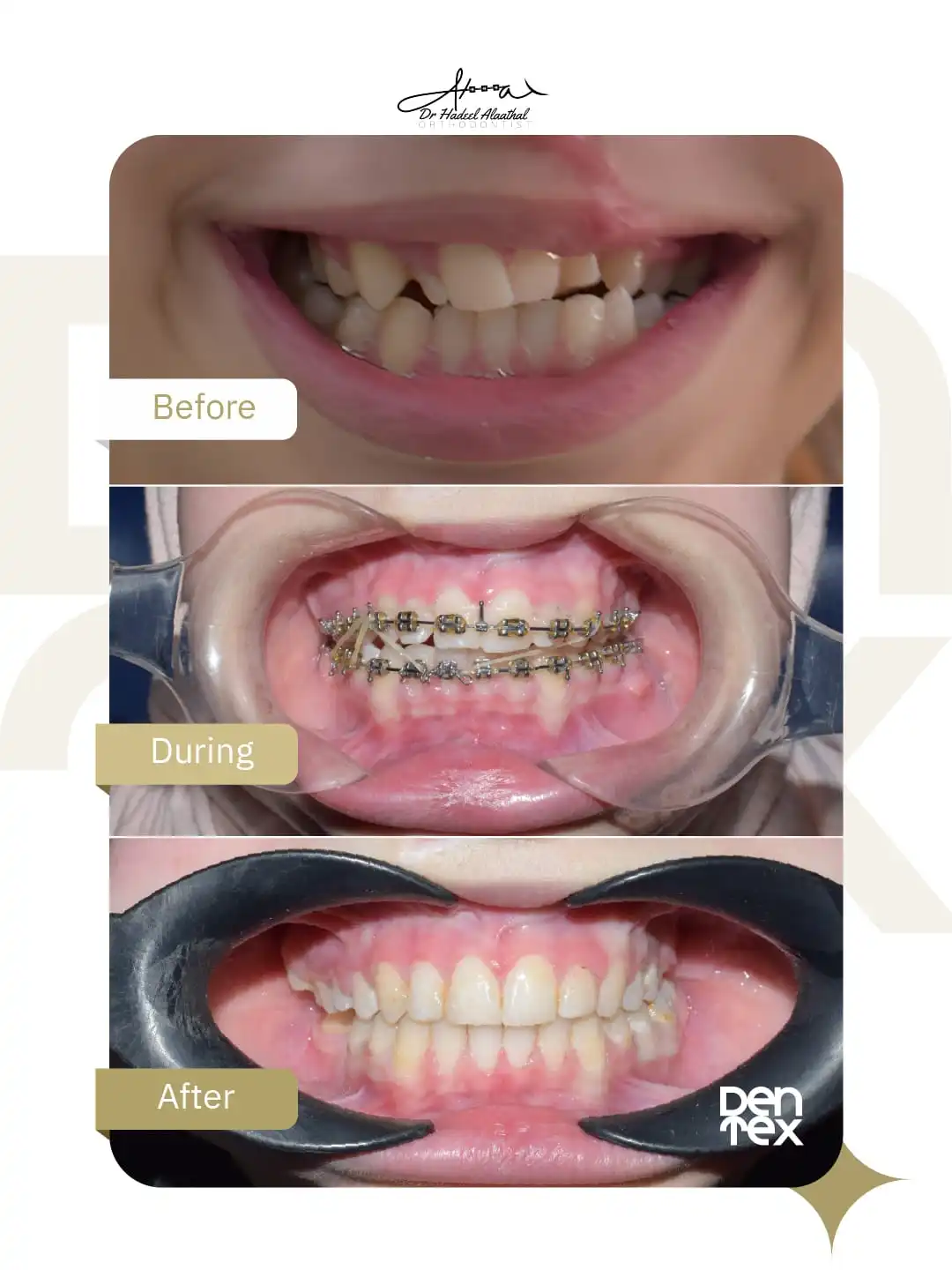 افضل عروض تقويم الاسنان في عيادة دنتكس