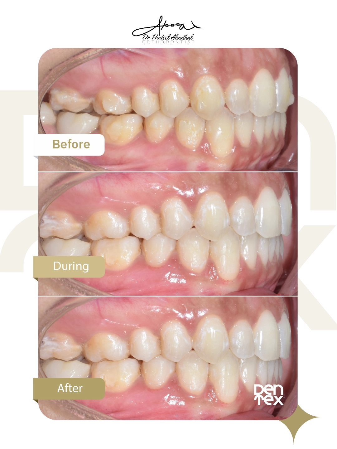 التقويم الشفاف قبل وبعد - عيادة اسنان دنتكس