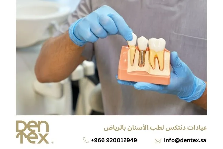 زراعة الاسنان بدون جراحة: تعرف على الحقائق كاملة