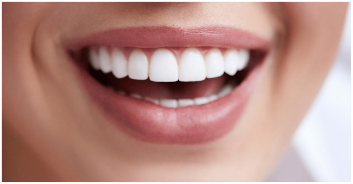 الفرق بين عدسات الأسنان وابتسامة هوليود | عيادة دنتيكس