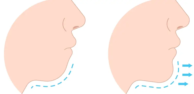 جراحة الفك مدة العملية وتكلفتها والنتائج قبل وبعد | عيادة دنتيكس