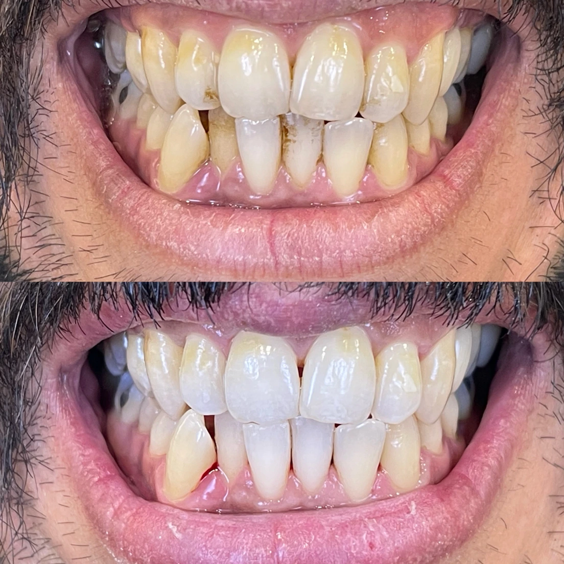 أفضل عيادة تنظيف وزراعة أسنان بالرياض - دنتكس