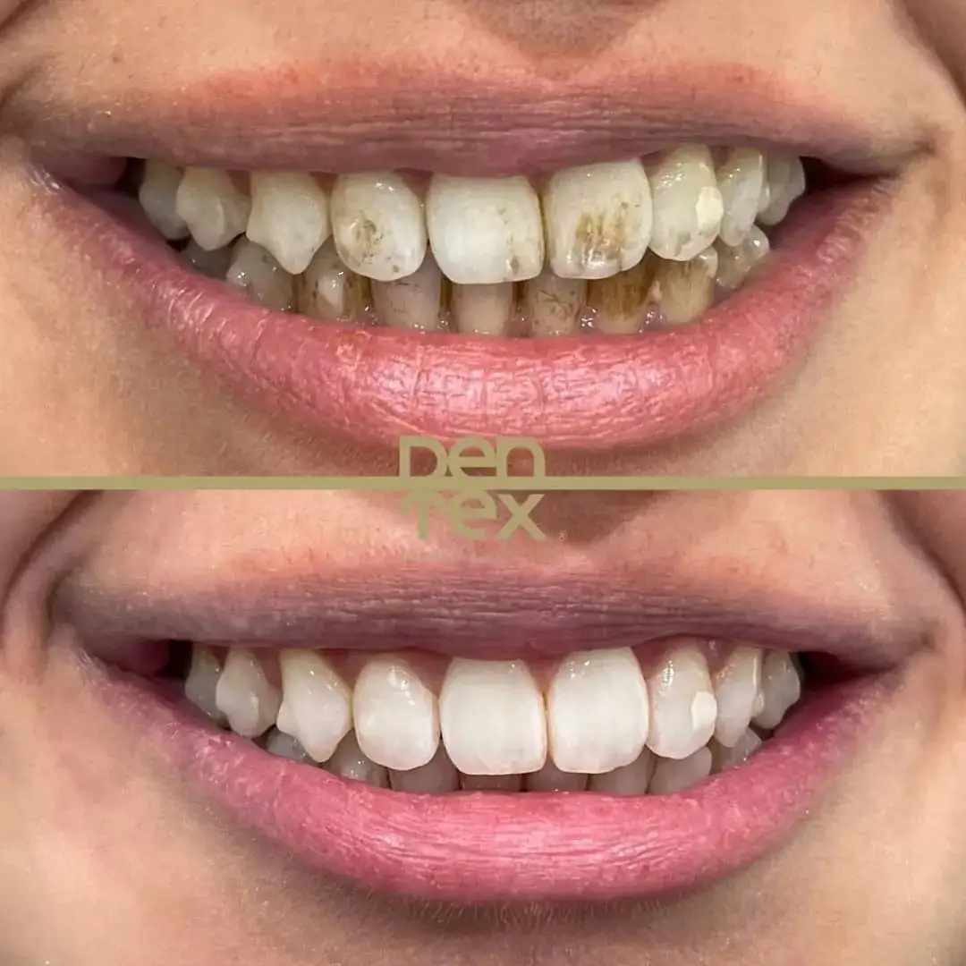 تبيض الأسنان قبل وبعد - عيادة دنتكس