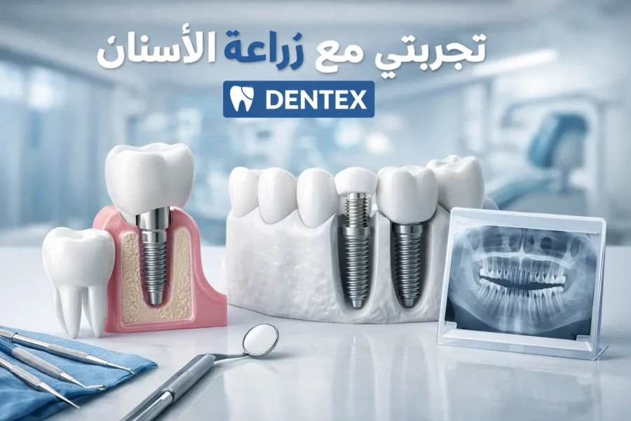 تجربتي مع زراعة الأسنان في دنتكس – أفضل دكتور أسنان بالرياض