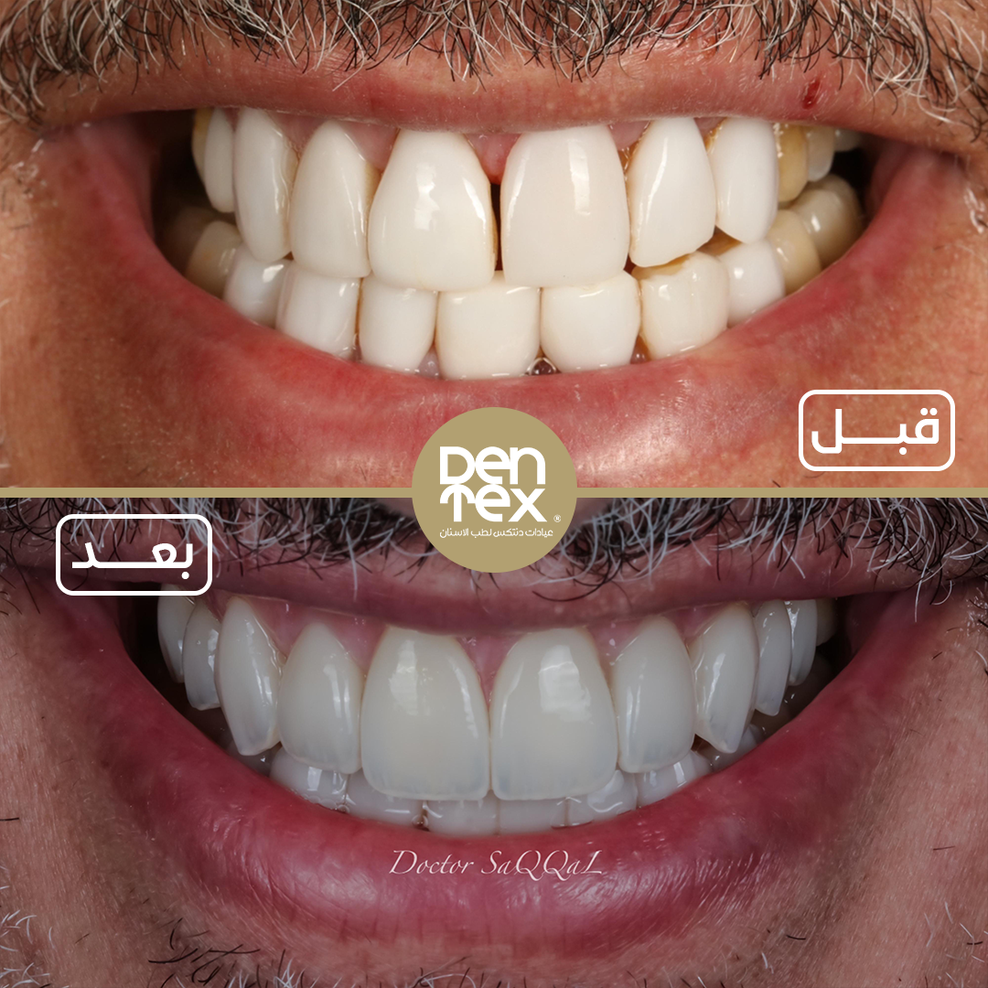 تجربتي مع عدسات الأسنان بالرياض في عيادة دنتكس 2025