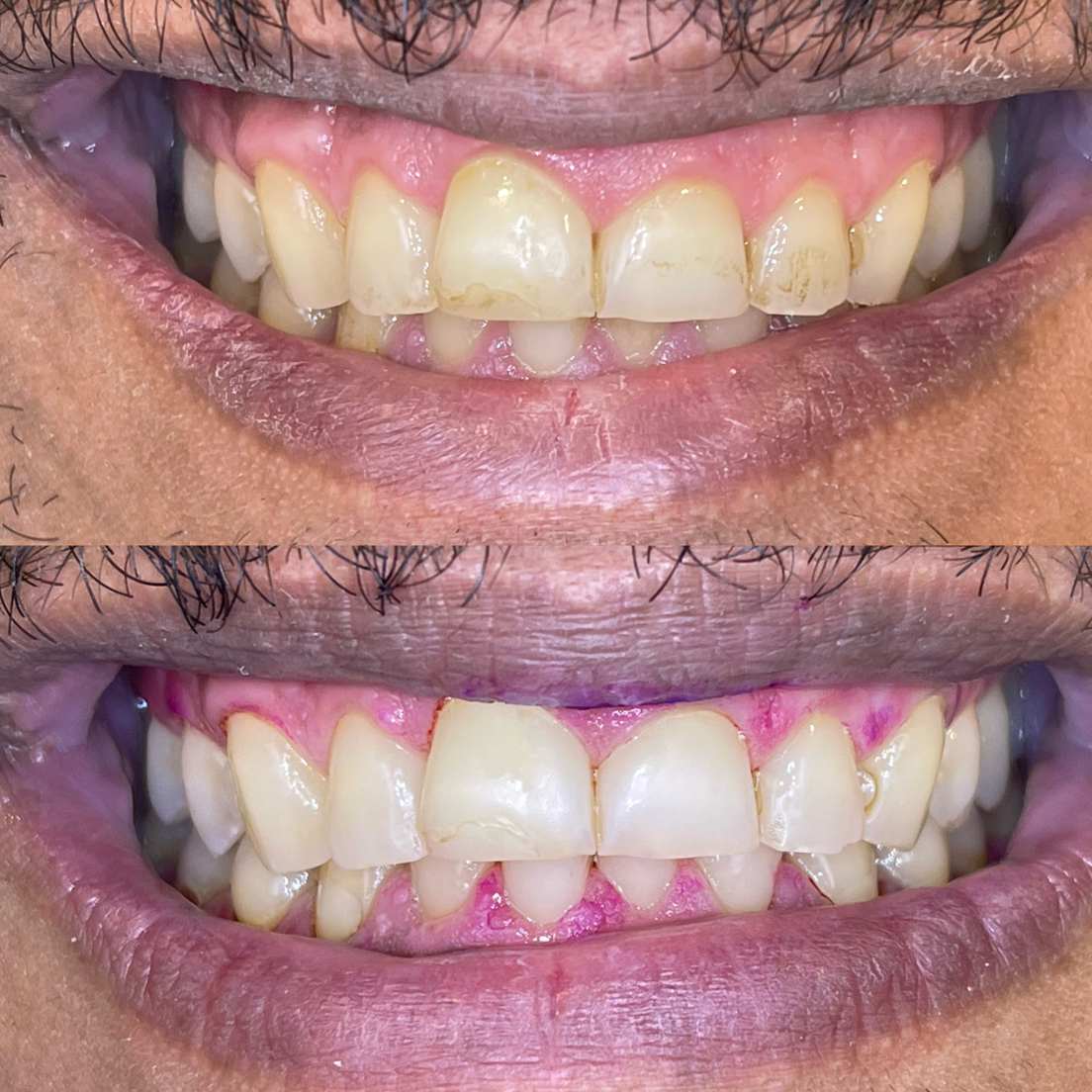 تنظيف اسنان قبل وبعد بتقنية GBT - عيادة دنتكس