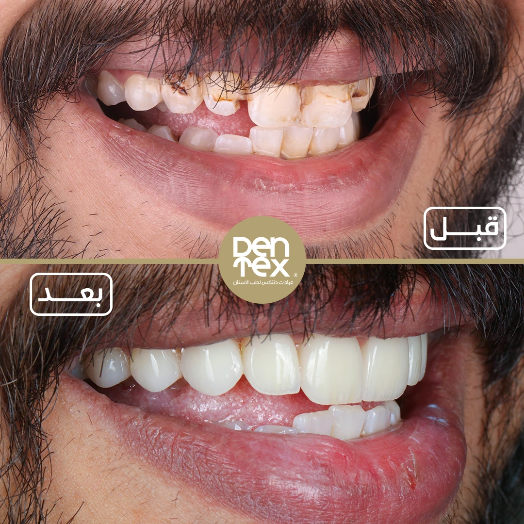 فينير الأسنان | أفضل عيادة أسنان بالرياض | دنتكس
