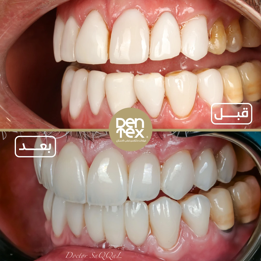 فينير الأسنان | أفضل عيادة أسنان بالرياض | دنتكس