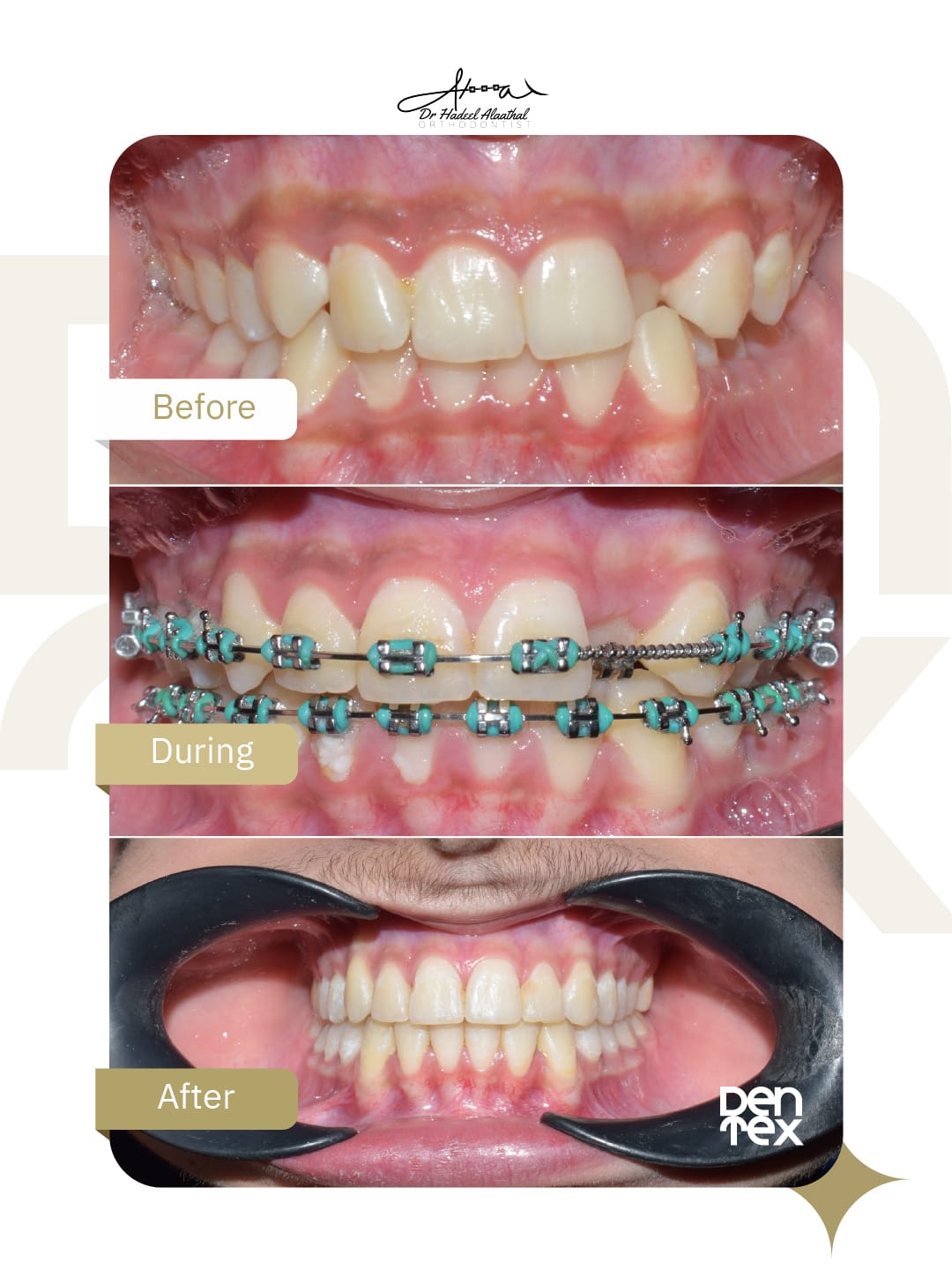 مراحل تقويم الأسنان قبل وبعد - عيادة دنتكس