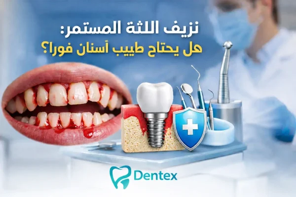 نزيف اللثة المستمر هل يحتاج طبيب اسنان فورًا؟ - دنتكس