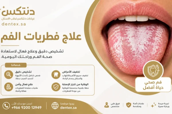 علاج فطريات الفم الأسباب والأعراض وأفضل علاج آمن - دنتكس