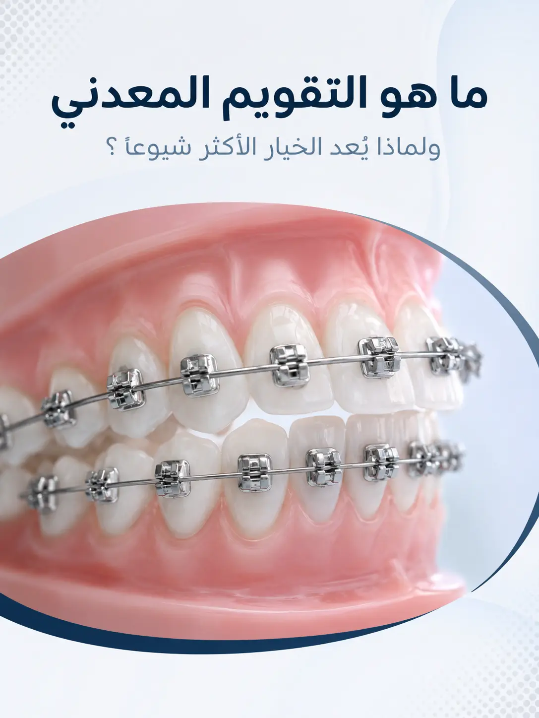 ما هو التقويم المعدني ولماذا يُعد الخيار الأكثر شيوعًا؟ - دنتكس