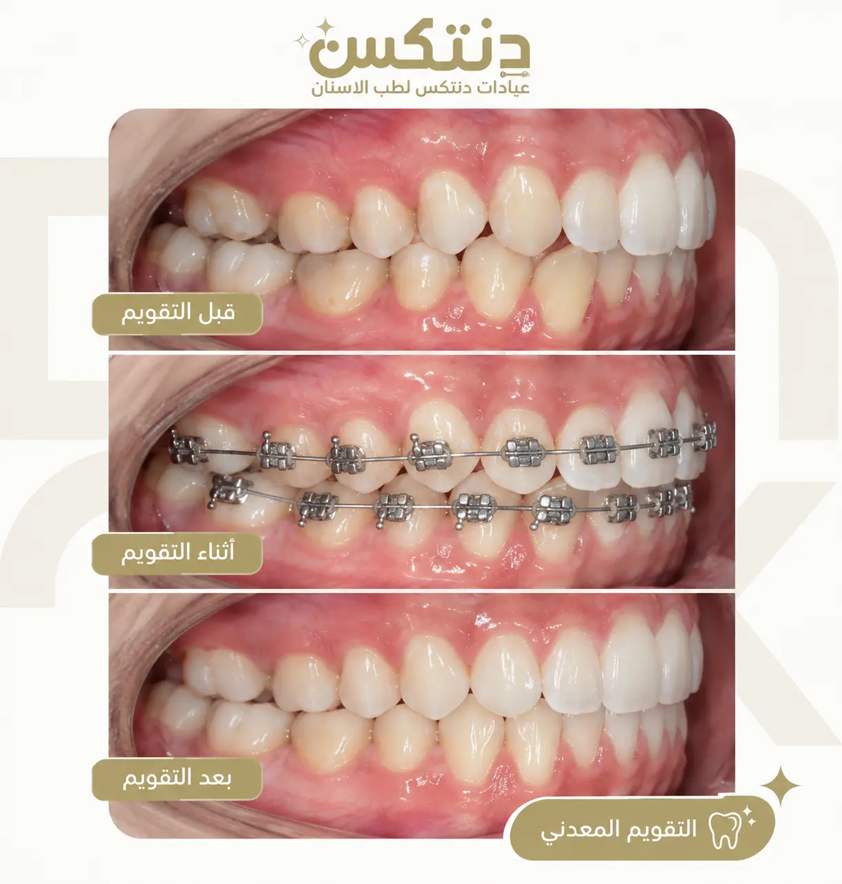 التقويم المعدني قبل وبعد في عيادة دنتكس