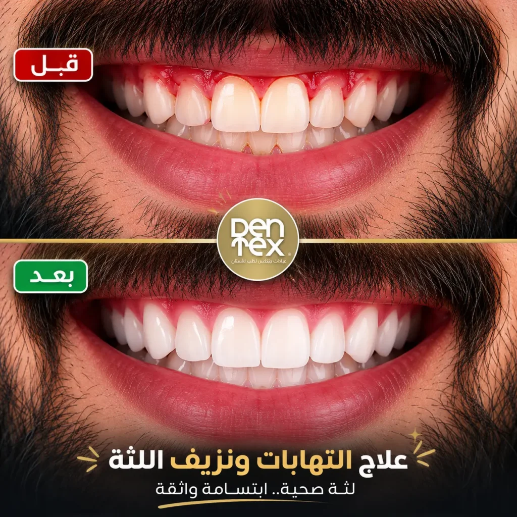 طرق علاج التهاب ونزيف اللثة - دنتكس