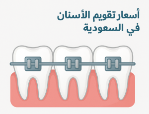 أسعار تقويم الأسنان في السعودية 2025 الأنواع والتكاليف