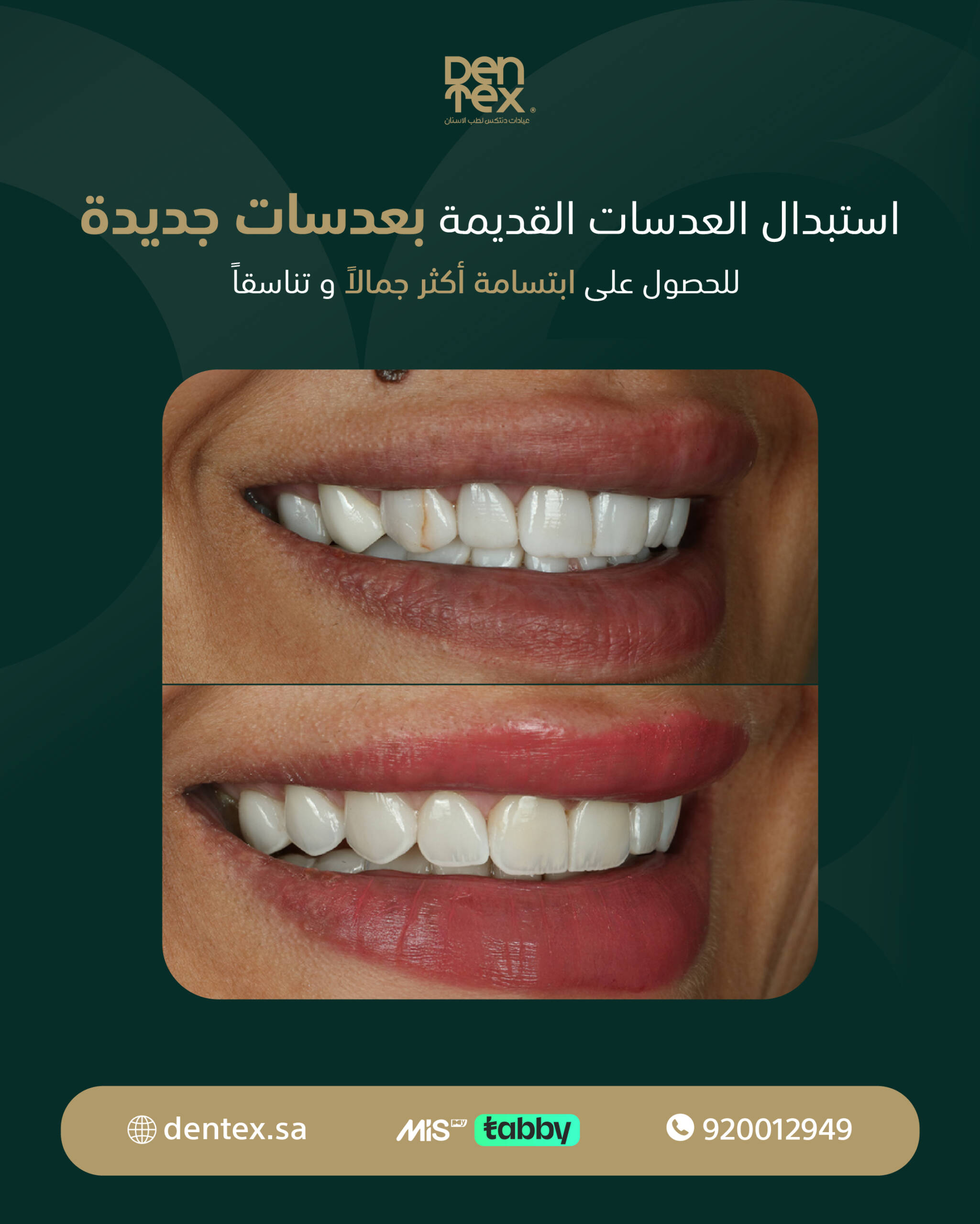 before-after DENTEX (1)