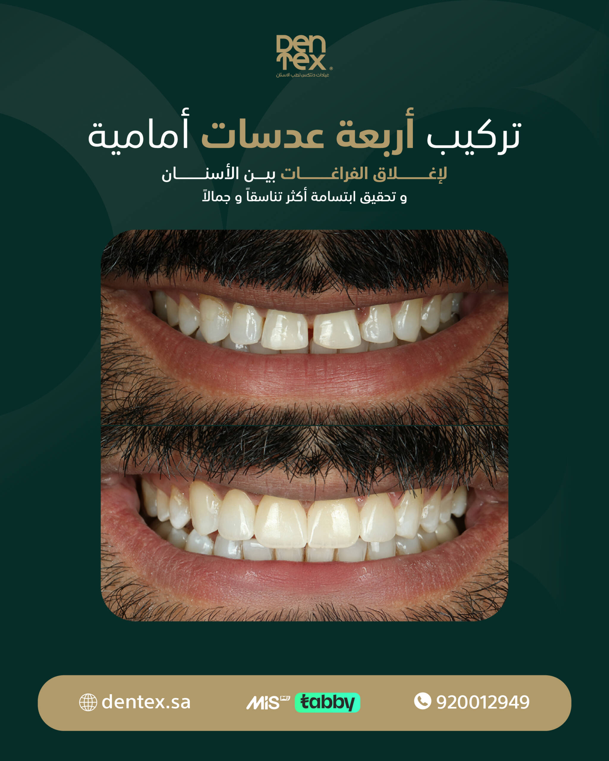 before-after DENTEX (2)